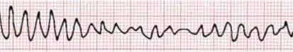 Ventricular Fibrillation