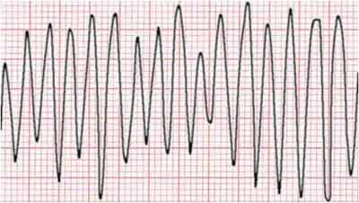 Ventricular Flutter