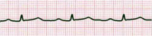 First Degree AV Block