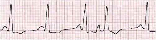 Atrial Extrasystoles