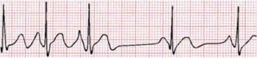 Atrial Extrasystoles