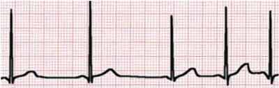 Normal EKG